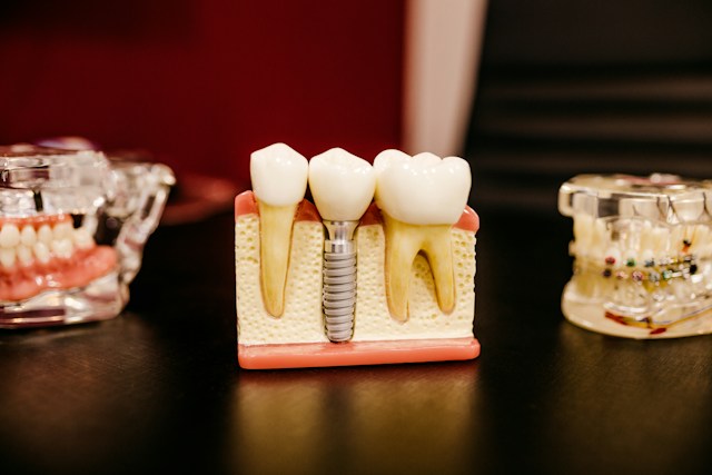 Dental implants in India: The complete cost and quality guide