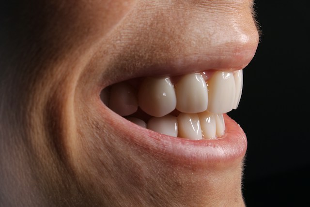 Veneers vs Crowns: Which is right for you?