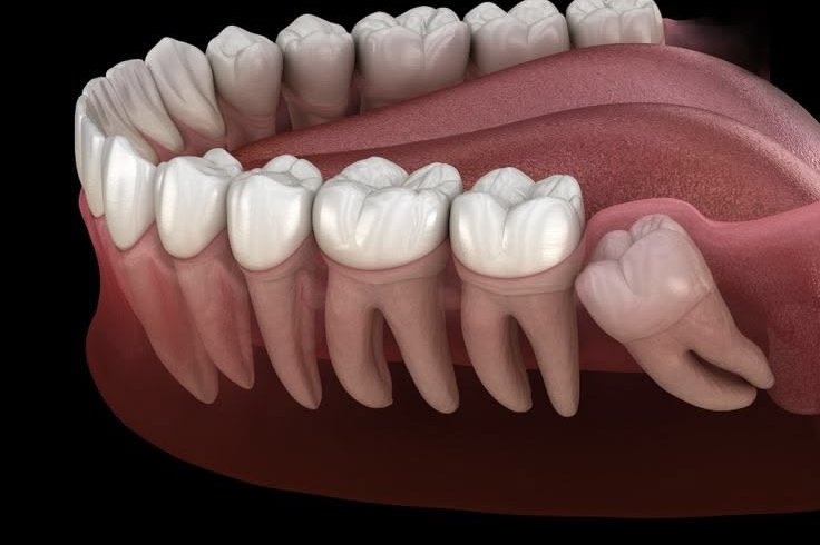 Wisdom tooth pain: does it always mean the tooth has to come out?