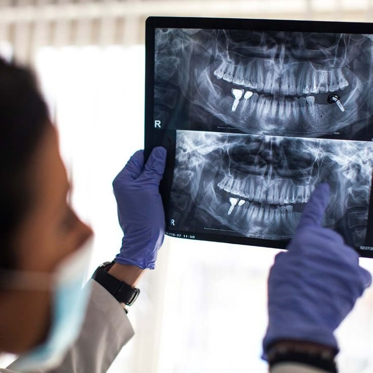 Dentist reviewing a panoramic X-ray showing dental implants, Ark Dental Global GK-1