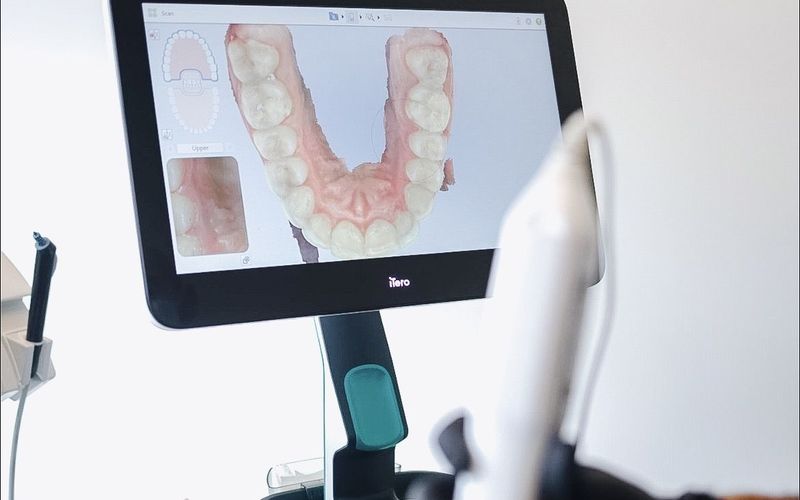iTero 3D scan of a patient's teeth for Invisalign planning at Ark Dental Global