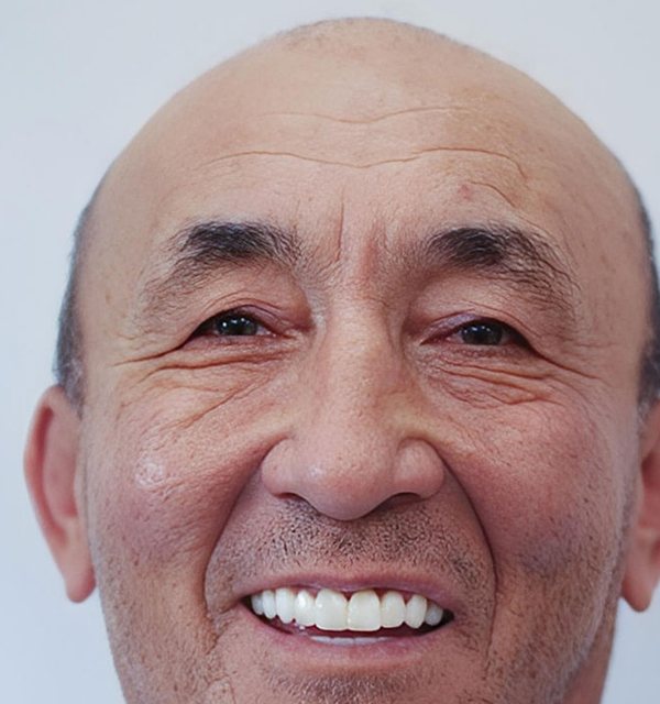 After Invisalign treatment, straight confident smile