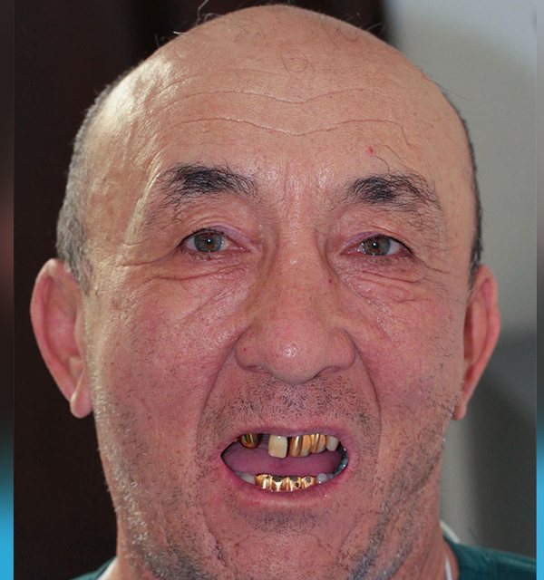 Before Invisalign treatment, misaligned teeth