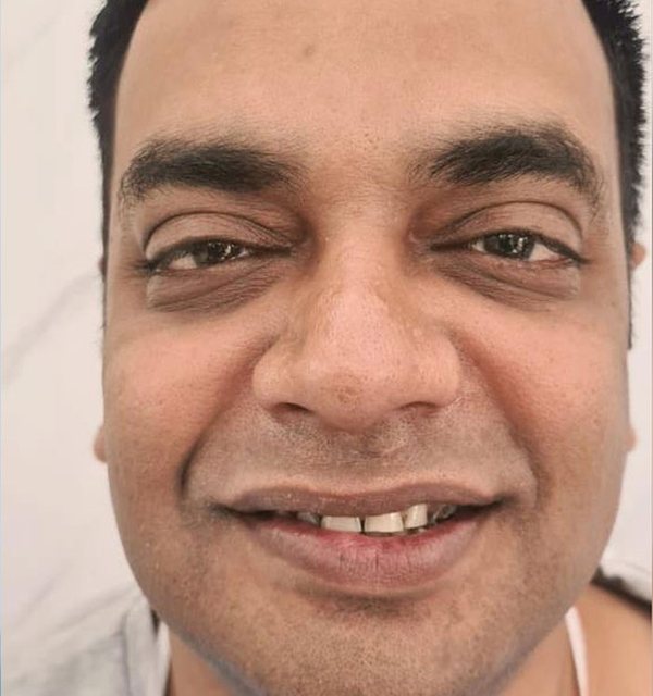 Before porcelain veneers