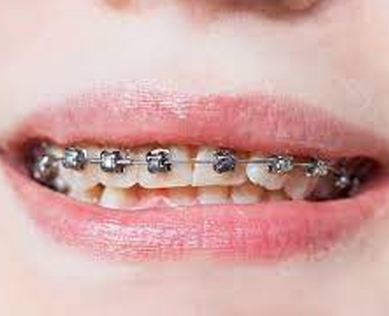 damon braces system, damon braces treatment, damon braces system in greater kailash-1, damon braces in delhi