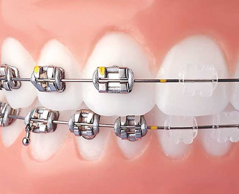 metal braces services in delhi ncr, orthodontic treatment in delhi, metal braces in greater kailash-1, orthodontic treatment, Ark Dental Clinic in GK-1, Best Ark Dental Clinic near me, Best Dental Clinic in New Delhi, Best Dental Clinic Near Me, Best Dental Clinic South Delhi